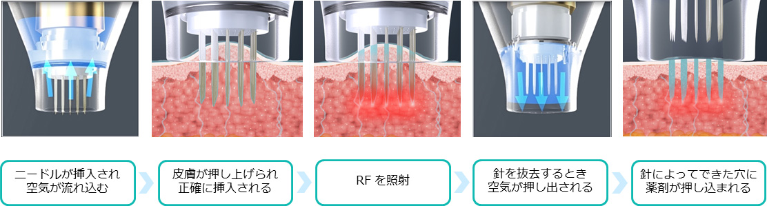 薬剤を均一に浸透させて治療を効果高めるドラッグデリバリーシステム