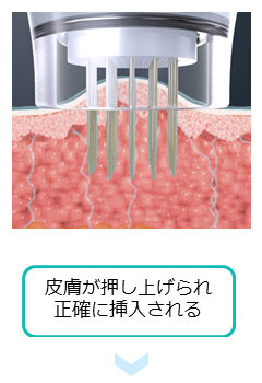 薬剤を均一に浸透させて治療を効果高めるドラッグデリバリーシステム