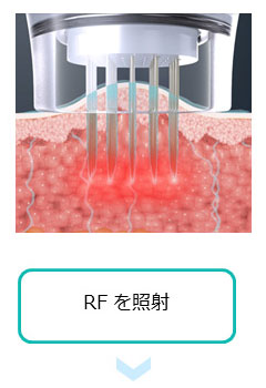 薬剤を均一に浸透させて治療を効果高めるドラッグデリバリーシステム