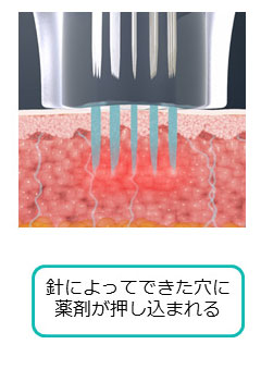薬剤を均一に浸透させて治療を効果高めるドラッグデリバリーシステム